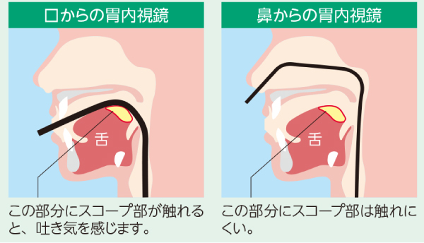 経鼻内視鏡検査のメリット